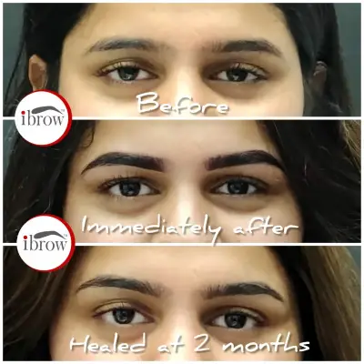 Before, Immediately After, and Healed at 2 Months: Stunning transformation with Permanent Eyebrow Makeup results.